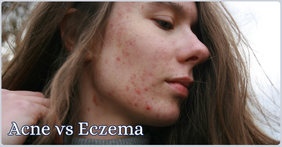 The Difference Between Acne and Eczema