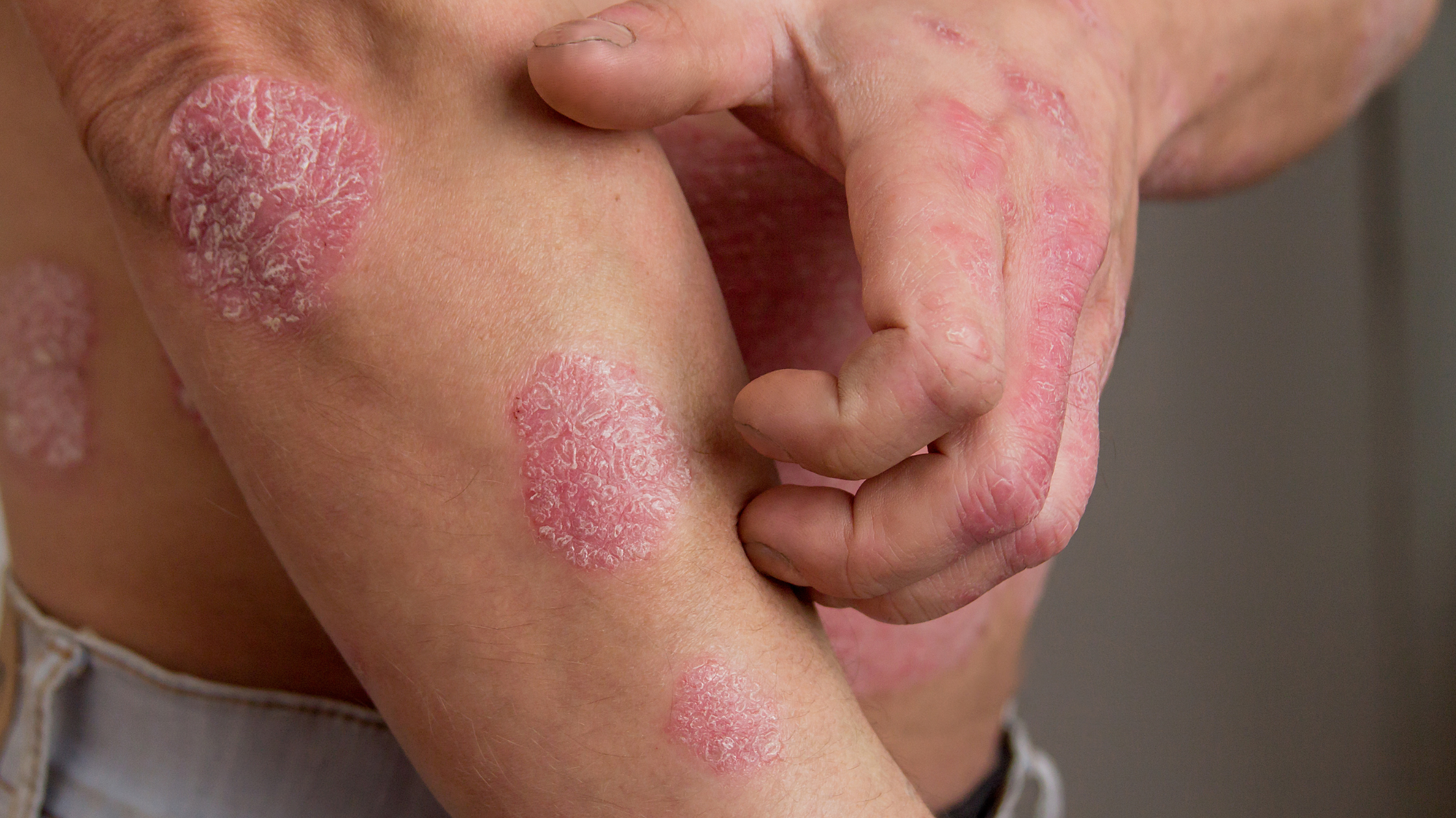 All About Psoriasis
