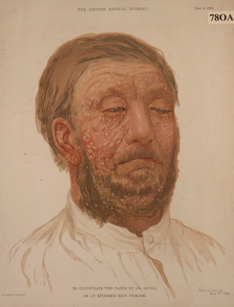 Is Eczema a new phenomenon?