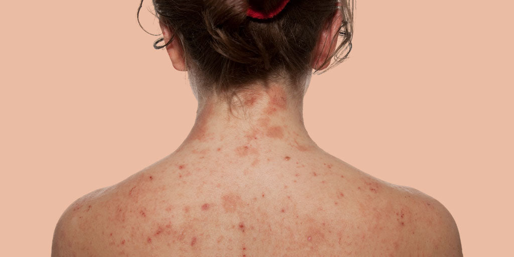 The Lowdown on Facial Eczema