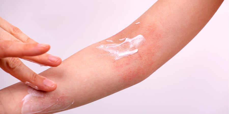 How do I apply eczema cream?