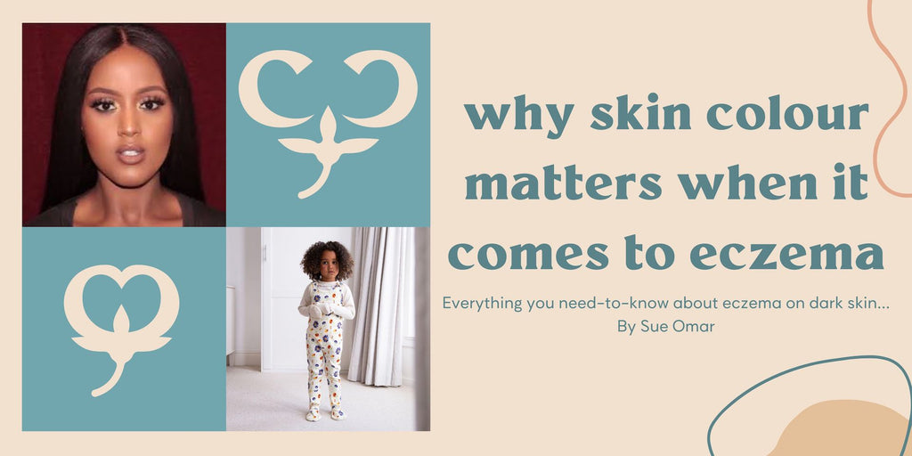 Why Skin Colour Matters When It Comes To Eczema