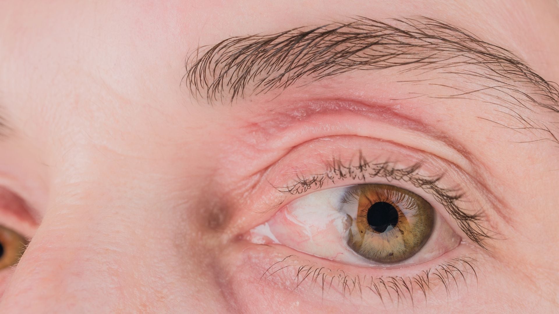 Caring for Eczema Around the Eyes and Eyelids