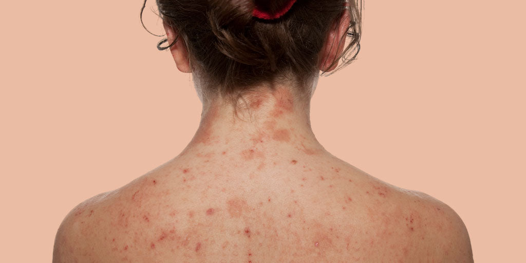 Lady with sore eczema on her back and neck